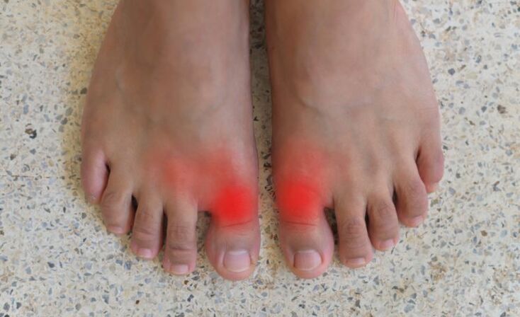 Pain in the toes with gout
